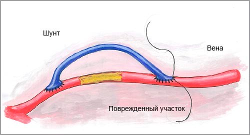 Шунтирование сосуда