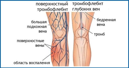 тромбоз глубоких вен на ногах