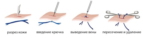 Флебэктомия