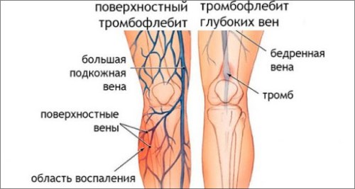 тромбофлебит вен наглядно