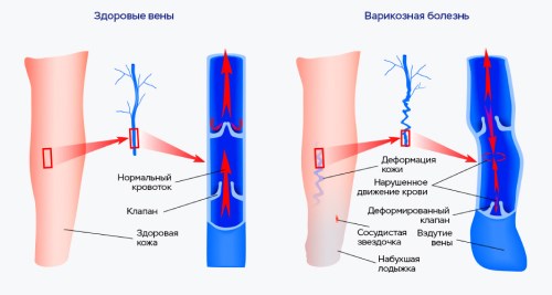 Варикозное расширение вен