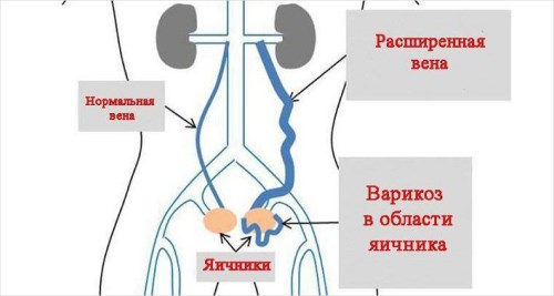 Варикоз малого таза у мужчины