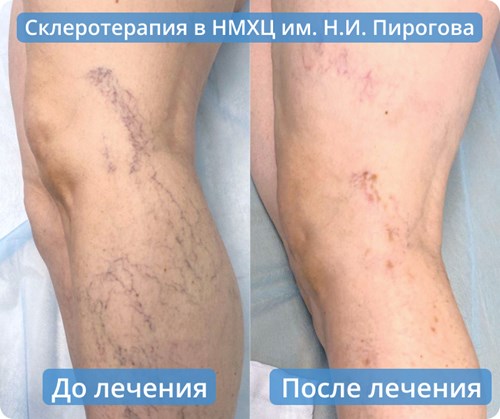 Склеротерапия до и после