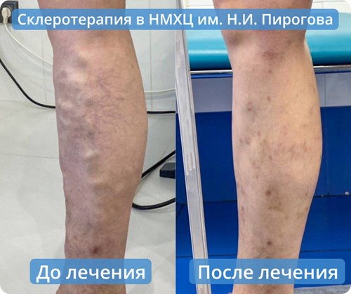 Осмотр после склеротерапии