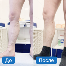 Варикозная болезнь