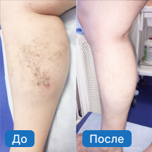 Варикозное расширение вен