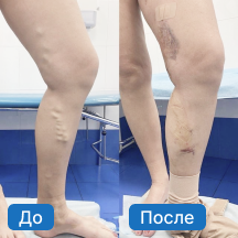 Варикозное расширение подкожных вен - лечение