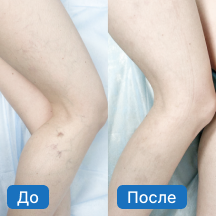 Лечение варикоза (результат)