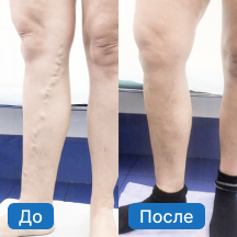 Лечение варикозной болезни