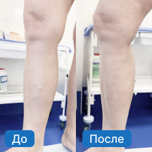 Лечение варикозной болезни