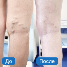 Расширение вен на ногах