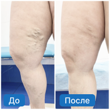 Варикоз вен - результат