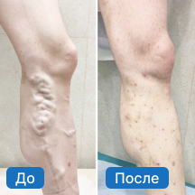 Расширение вен на ногах