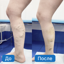 Варикозное расширение подкожных вен