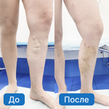 Лечение варикозной болезни