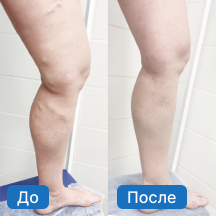 Варикоз вен