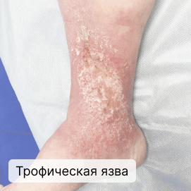 Трофическая язва