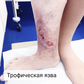 Трофическая язва на ноге