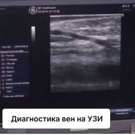 Эхосклеротерапия