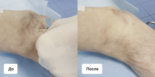 Эхосклеротерапия