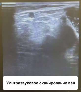 Трофическая язва