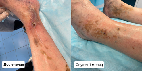 Трофическая язва